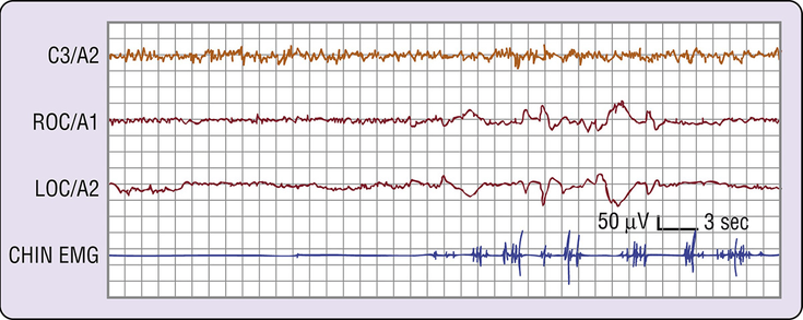 Figure 2-4: Polysomnography of Patient in REM Sleep. Notes: On the left side is a burst of several rapid eye movements (out-of-phase deflections in right outer canthus [ROC]/A1 and left outer canthus [LOC]/A2). On the right side, there are additional rapid eye movements as well as twitches on the electromyographic (EMG) lead. The interval between eye movement bursts and twitches illustrates tonic REM sleep. Source:  Kryger MH, et al, eds. <em>Principles and Practice of Sleep Medicine. 7th ed</em>. Philadelphia, PA: Elsevier Saunders; 2022.