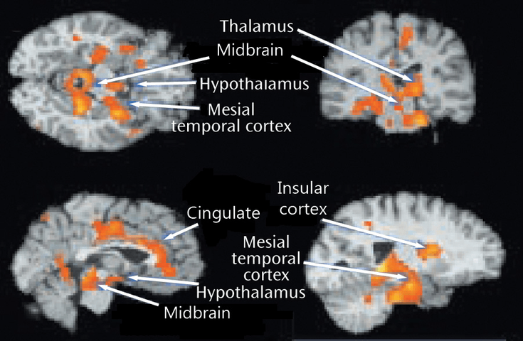 Figure 4-4: Increased Metabolic Brain Activity in Patients With Insomnia. Source: Nofzinger EA, et al. Am J Psychiatry. 2004;161(11):2126-2128.