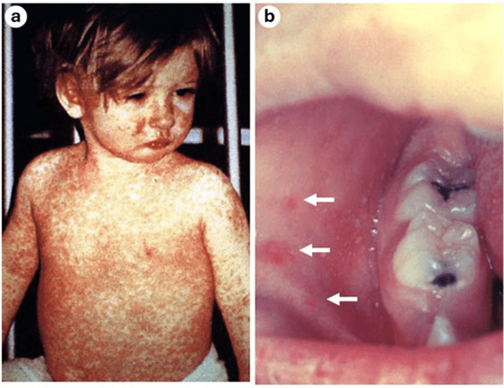 Figure 2-1:  Common Dermatologic Symptoms of Measles. The characteristic maculopapular skin rash of measles (a). Koplik spots (b; white arrows) are pathognomonic for measles. Images are United States Government (CDC) work and are in the public domain.