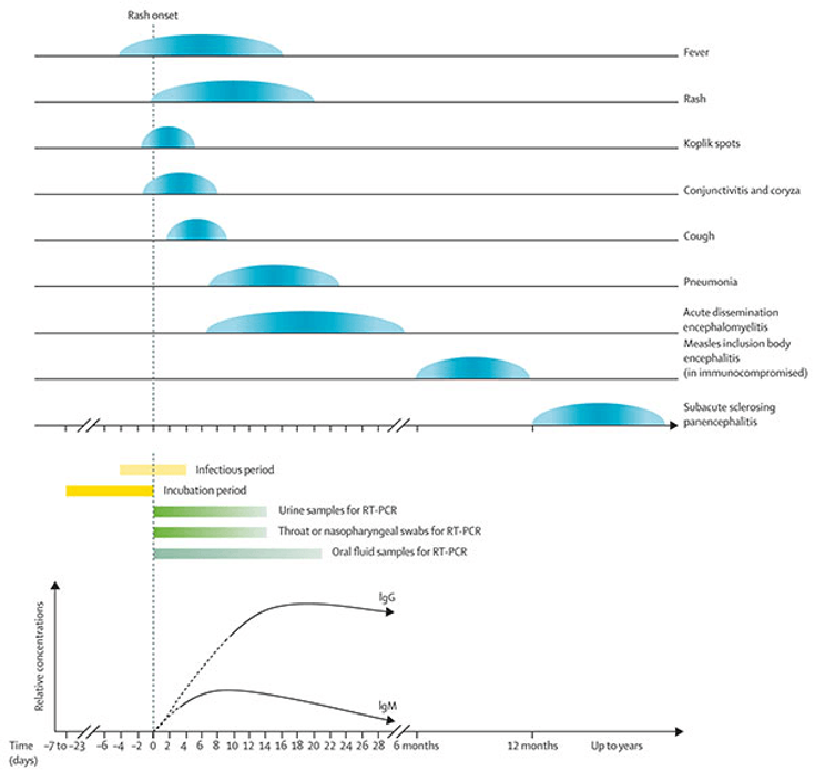 Figure 2-2: Time Course of a Typical Measles Infection.  Clinical symptoms are usually milder (modified measles) or absent for vaccinated individuals and IgM antibodies might not be detectable. Not all of the symptoms shown will be present in all individuals with measles: pneumonia (1-6 per 100 children with measles in in middle-income to high-income countries), acute disseminated encephalomyelitis (~1 per 1,000 cases), measles inclusion body encephalitis (very rare), and the subacute sclerosing panencephalitis (6.5-11 per 100,000 cases) are comparably rare. Source: Modified from: Hübschen JM, Gouandjika-Vasilache I, Dina J. Measles. Lancet. 2022;399(10325):678-690.