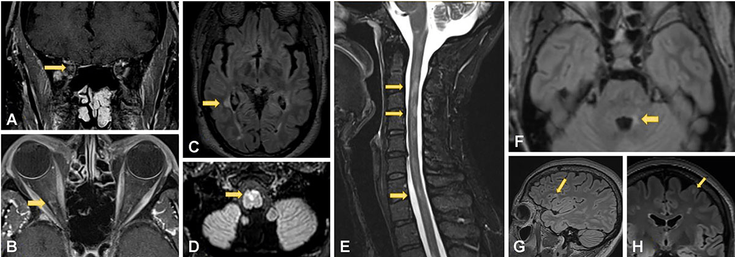 Figure 2-1: Regions of Lesion Formation.  A (coronal) and B (axial): MRI T1-post contrast images show enhancement in the intraorbital segment of the optic nerve consistent with right optic neuritis (arrows). C: Right posterior periventricular lesion on axial T2-FLAIR (arrow). D: Ventral medullary demyelinating lesion on T2-FLAIR (arrow). E: MR cervical cord sagittal STIR demonstrating C2-3, C4, and C7 demyelinating lesions (arrows). F: Axial T2-FLAIR with demyelinating lesion in left brachium pontis (arrow). G (sagittal) and H (axial): T2-FLAIR images demonstrate left frontal juxtacortical demyelinating lesion (arrows). Source: Adapted from: Baskaran AB, et al. J Clin Neurol. 2023;19(3):217