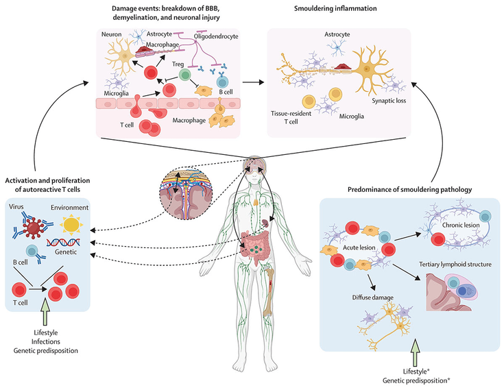 Figure 1-4: The Pathophysiology of Multiple Sclerosis.  Multiple sclerosis is a complex disease in which innate and adaptive immune cells reach the CNS via different routes, including the gut and meninges, and play a role in acute focal and chronic smoldering pathology that is present in both the relapsing and progressive course of the disease. Lifestyle factors, such as nutrition, environmental factors, infections, and genetics, influence both initiation and progression of the disease. BBB, blood-brain barrier. *The exact mechanisms by which lifestyle and genetic predispositions influence the acute and smoldering pathology remain unknown. Source: Adapted from: Jakimovski D, et al. <em>Lancet</em>. 2024;403(10422):183-202. 