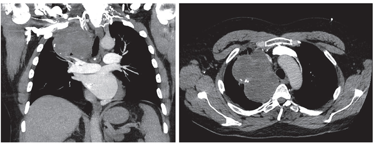 Figure 2-1:  Example Lung Cancer CT Radiograph. Lung cancer CT radiograph showing the extent of local tumor invasion and invasion of surrounding structures. Source: Modified from: Pannu J, et al. Lung cancer: Diagnostic techniques. In Lung Cancer: an Evidence-Based Approach to Multidisciplinary Management. Elsevier. 2023.