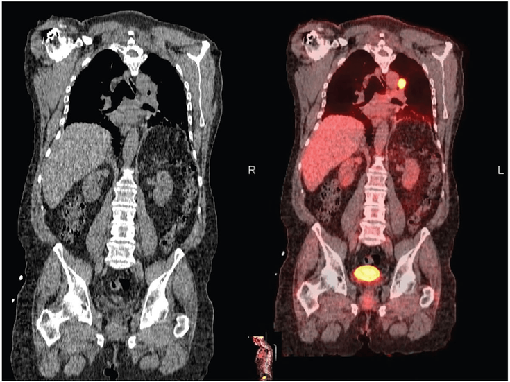 Figure 2-2:  Example Lung Cancer CT and PET/CT Radiographs. Combining concurrent CT images with a PET scan increases staging accuracy. A figure-guided detection of lung cancer with CT (left) and integrative PET/CT (right) is shown. Modified from: Pannu J, et al. Lung cancer: Diagnostic techniques. In Lung Cancer: an Evidence-Based Approach to Multidisciplinary Management. Elsevier. 2023.