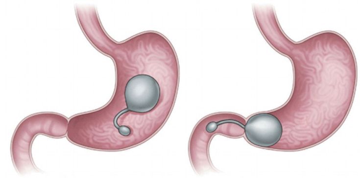 Figure 10-10: TransPyloric Shuttle. The TPS consists of two balloons connected by a catheter: the smaller oval balloon is positioned in the duodenum and the larger in the pylorus, providing more rapid filling and slower gastric emptying. Source: Choi YI, et al. <em>Clin Endosc</em>. 2018;51(5):420-424.