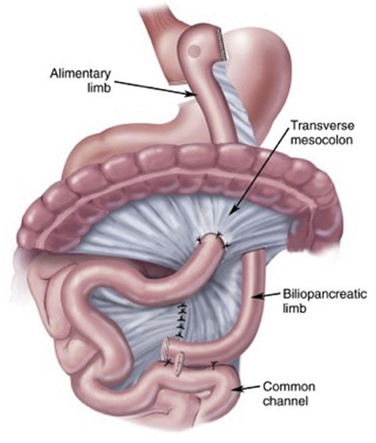 Figure 10-11: Roux-en-Y Gastric Bypass. The RYGB surgery restricts food intake and also decreases how food is absorbed. A new stomach pouch is created from which food flows directly into the small intestine, bypassing the stomach, duodenum, and the upper intestine. Source: Mehta M, et al. <em>Endocr Pract</em>. 2021;27(6):626-635.