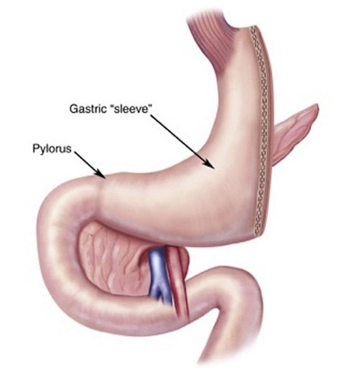 Figure 10-12: Laparoscopic Sleeve Gastrectomy. The LSG procedure removes most of the stomach, restricting food intake by decreasing the amount of food that can be ingested. Source: Mehta M, et al. <em>Endocr Pract</em>. 2021;27(6):626-635. 