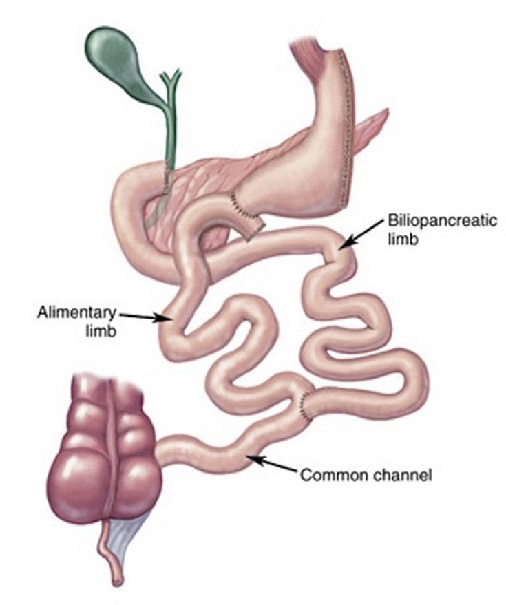 Figure 10-13: Biliopancreatic Diversion With Duodenal Switch. Biliopancreatic diversion with duodenal switch involves three features: removal of a large part of the stomach (see LSG), a duodenal switch that re-routes food away from much of the small intestine, and a change in how bile and other digestive juices affect how the body digests food and absorbs calories. Source: Mehta M, et al. <em>Endocr Pract</em>. 2021;27(6):626-635.