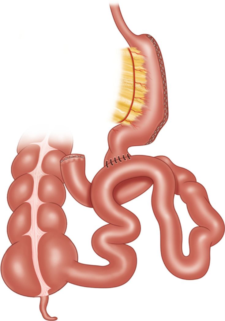 Figure 10-14: Single Anastomosis Duodeno-Illeal. Switch (SADI-S). SADI-S is a procedure that combines a sleeve gastrectomy and an end-to-side duodeno-ileal diversion which creates a 200-300 cm channel from the pylorus to the ileocecal valve. Source: Ruano A, et al. In: Lutfi, R, Palermo M, Cadière GB, eds. <em>Global Bariatric Surgery</em>. Springer, Cham.2018.