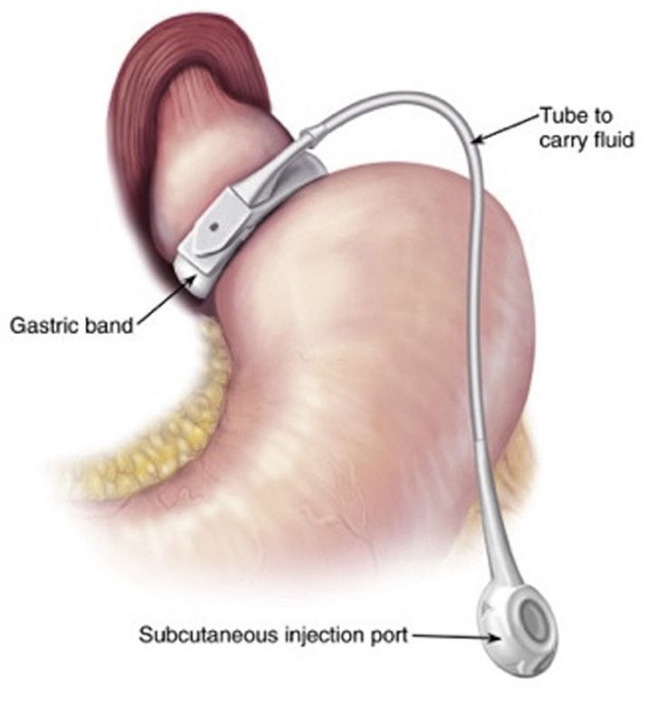 Figure 10-15: Adjustable Gastric Band. AGB surgery restricts food intake by placing a small band around the top of the stomach, enabling restriction of the size of the opening from the throat to the stomach. This opening can be adjusted by the surgeon utilizing a circular balloon inside the band. The balloon can be deflated or inflated using saline solution as needed to accommodate the patient’s needs via an access port. Mehta M, et al. <em>Endocr Pract.</em> 2021;27(6):626-635. 