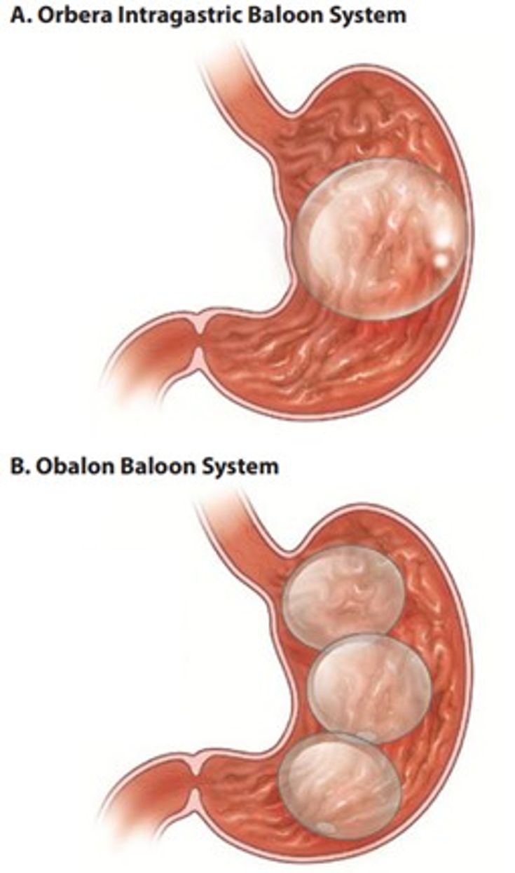 Figure 10-2: Intragastric Balloons. Balloons are introduced into the stomach either endoscopically or by swallowing a capsule and then inflated with air or saline to the desired volume, reducing gastric volume and altering stomach motility, and leading to increased satiety. A, the Orbera balloon system. B, the Obalon balloon system. Source: Sullivan S, et al. <em>Gastroenterology</em>. 2017;152(7):1791-1801.