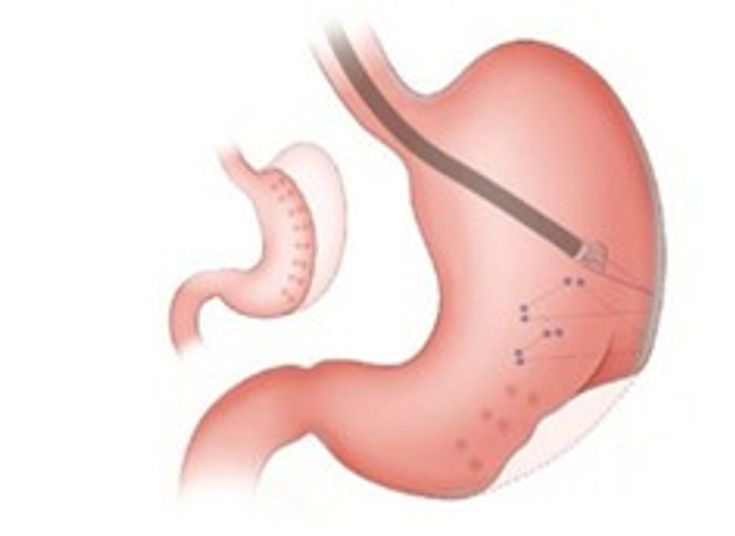 Figure 10-3: Endoscopic Sleeve Gastroplasty. Endoscopic sleeve gastroplasty uses an endoscopic suturing device to stitch together the anterior and posterior stomach walls and create a tubular structure. Source: Sullivan S, et al. <em>Gastroenterology</em>. 2017;152(7):1791-1801.