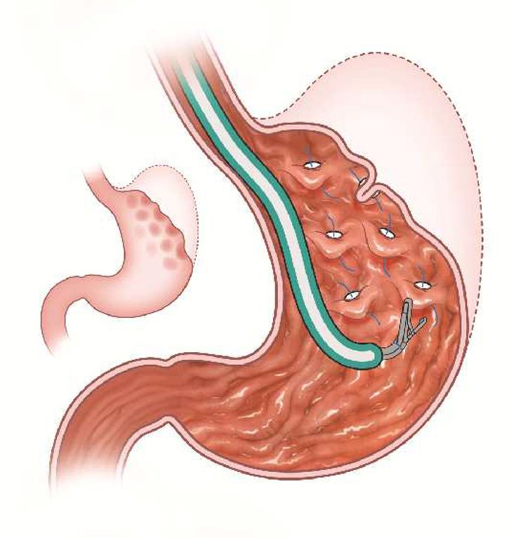 Figure 10-4: Primary Obesity Surgery Endolumenal. Primary obesity surgery endolumenal is a minimally invasive procedure that folds stomach tissue in the fundus and distal body using a suture and specialized tissue anchors, preventing fundal accommodation and inducing antral dysmotility, which leads to increased satiety. Source: Sullivan S, et al. <em>Gastroenterology</em>. 2017;152(7):1791-1801