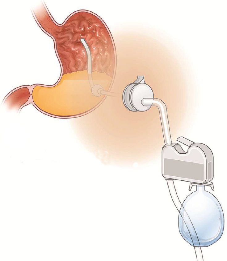 Figure 10-7: Aspiration Therapy. Patients can use the AspireAssist device to aspirate ~30% of the ingested calories after each meal. Source: Sullivan S, et al. <em>Gastroenterology</em>. 2017;152(7):1791-1801.