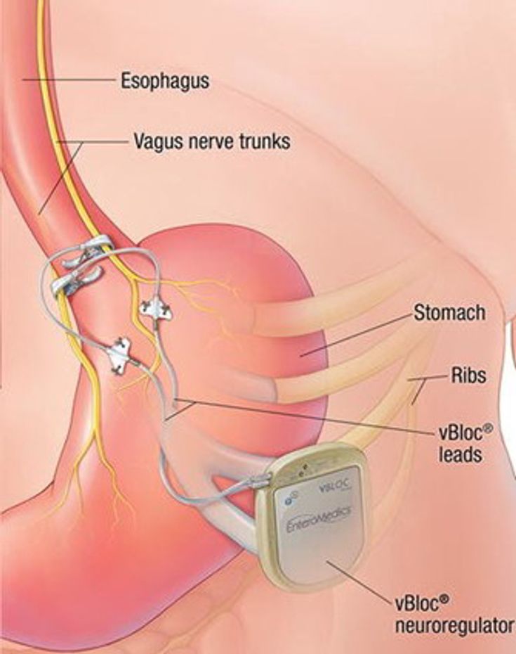 Figure 10-9: vBloc. The vBloc is a laparoscopically-implantable device which delivers ~12 hours of electric pulses to the intraabdominal vagal nerve trunks, decreasing the feeling of hunger. Source: Enteromedics, Inc.