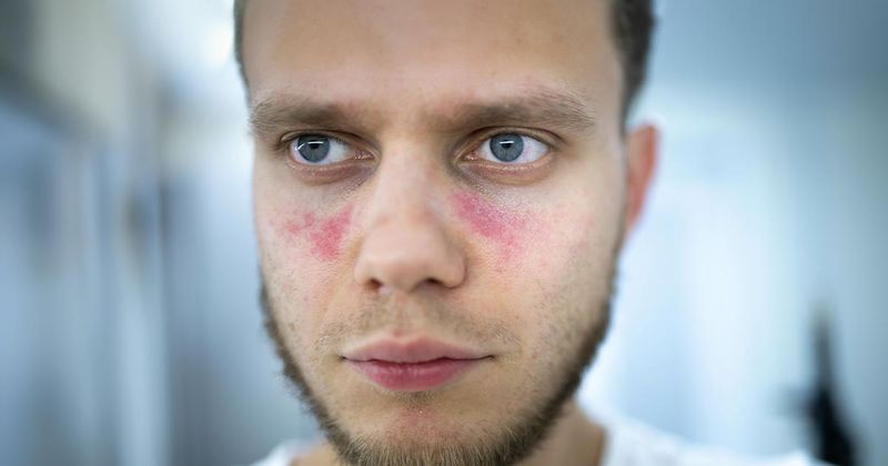 A rash on the face of a patient with lupus.