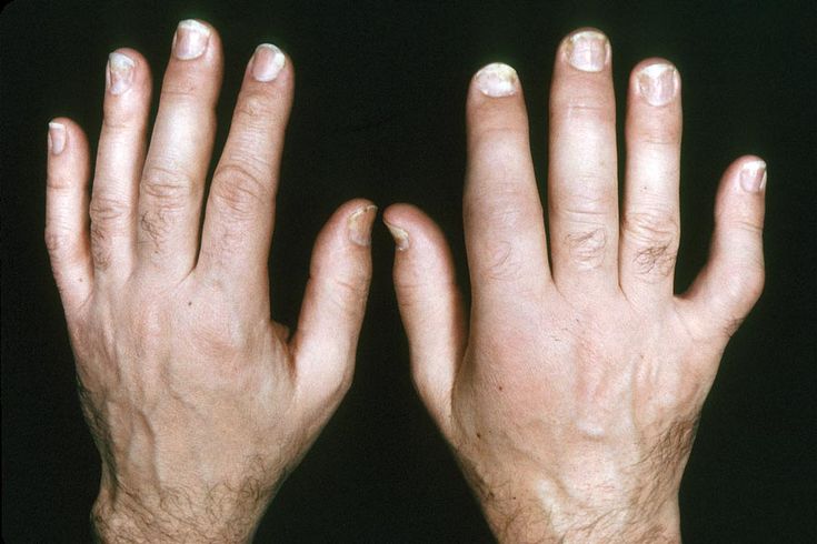 Figure 3-2: PsA: Symmetrical Polyarthritis: Soft-tissue swelling is present in the second MCP joints of both hands and in the second, third, and fifth proximal interphalangeal joints of the right hand in this patient with PsA. These changes closely resemble those found in RA.  Source: American College of Rheumatology. Rheumatology Image Bank. http://images.rheumatology.org/. Image No. 99-07-0018. Accessed November 3, 2014.