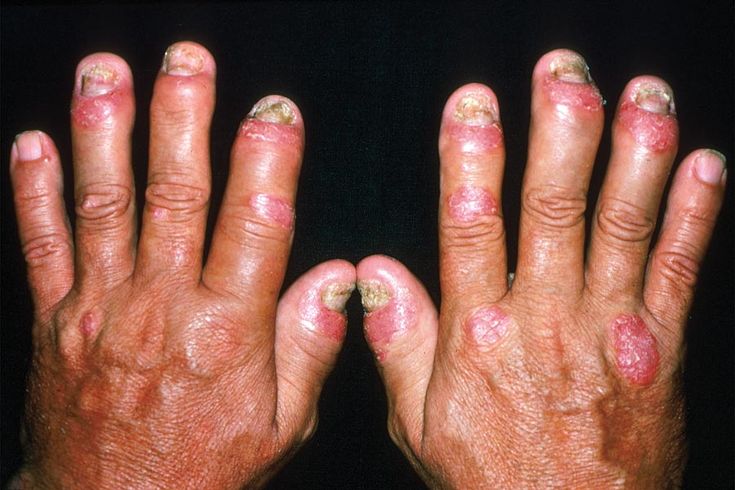 Figure 3-3: PsA: DIP Arthritis: Swelling and deformity of DIP joints are present together with typical psoriatic involvement of the skin and nails. Source: American College of Rheumatology. Rheumatology Image Bank. http://images.rheumatology.org/. Image No. 99-07-0017. Accessed November 3, 2014.