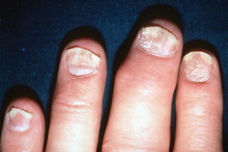 Figure 3-4: PsA: Nail Changes: Punctate pitting of the nail is a common finding in patients with PsA. The pitting is most clearly seen on the index finger. The distal portions of all the nails have lifted up (onycholysis). Source: American College of Rheumatology. Rheumatology Image Bank. http://images.rheumatology.org/. Image No. 99-07-0020. Accessed November 3, 2014.