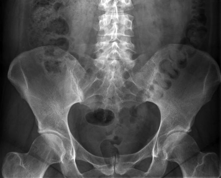 Figure 3-5: PsA: Asymmetric Sacroiliitis: Psoriatic arthritis X-ray.  Source: Rapidedia: The Radiology Encylopedia Web site. http://www.radipedia.com/WikiMedia/index.php?title= File:PsoriaticArth1.jpg. Accessed April 9, 2018.