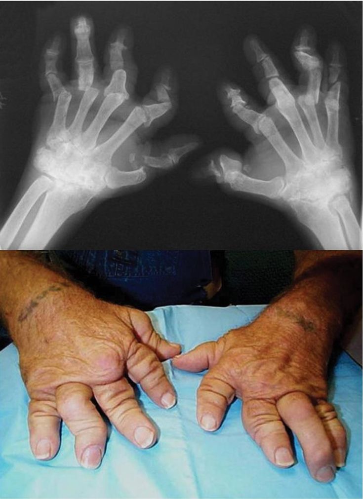 Figure 3-6: PsA: Hands, Arthritis Mutilans: The radiograph (top) shows deformities of the digits from resorption of bone and dissolution the joints. The clinical image (bottom) shows redundant overlying skin from foreshortening of the fingers that leads to a telescoping motion of the digit.  Source: American College of Rheumatology. Rheumatology Image Bank. http://images.rheumatology.org/. Image No. 05-07-0064. Accessed November 3, 2014.