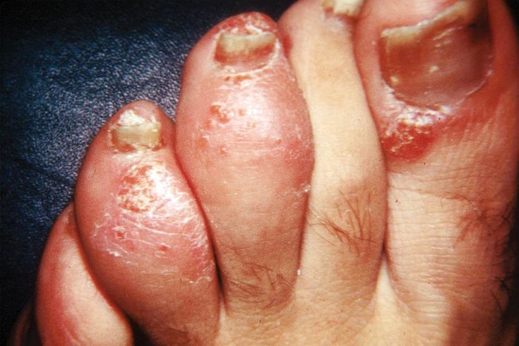 Figure 3-8: PsA: Dactylitis or “Sausage” Digits: Psoriasis involving the first, third, and fourth toes is accompanied by PsA of interphalangeal joints of the third and fourth toes. The “sausage shape” of these toes is caused by soft-tissue swelling more marked than that usually seen in RA. Source: American College of Rheumatology. Rheumatology Image Bank. http://images.rheumatology.org/. Image No. 99-07-0025. Accessed November 3, 2014.