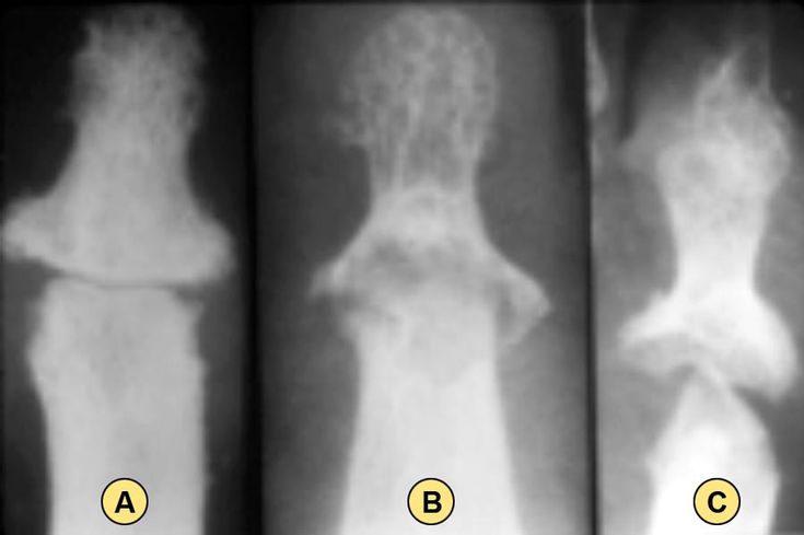 Figure 5-10: PsA: Progressive Joint Changes