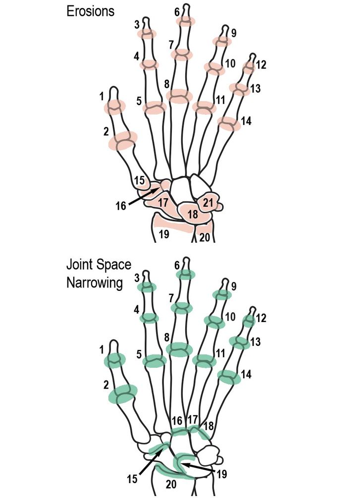 Figure 5-11: PsA: Modified Sharp Scoring Method 