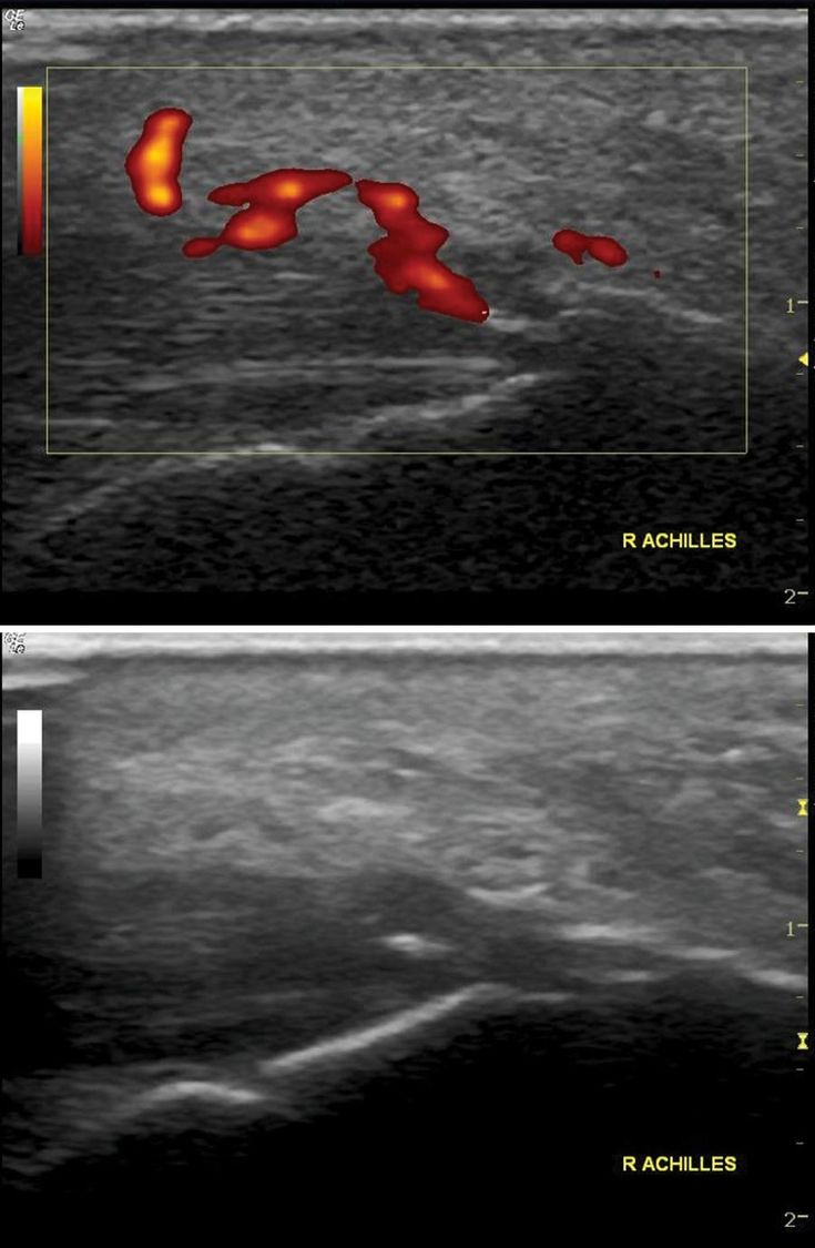 Figure 5-12: Inflammation and New Bone Formation Next to Joint Shown on Ultrasound