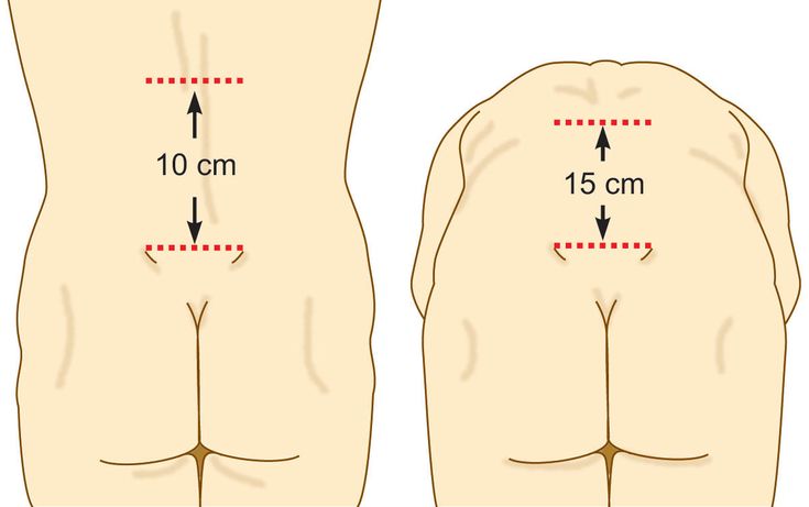 Figure 5-7: Schober’s Test of Lumbar Flexion