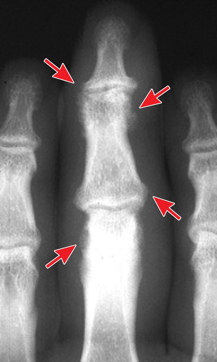 Figure 5-9: Periostitis and Distal Tuft Resorption