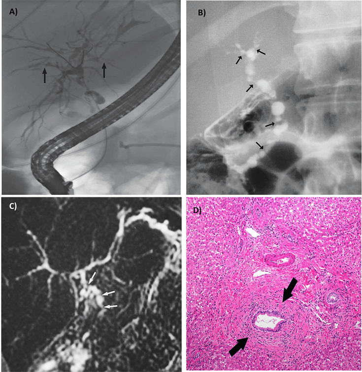 Figure 6-5: Primary Sclerosing Cholangitis. Key: A) PSC showing typical irregular bile ducts with multifocal strictures on ERCP. B) ERCP image showing multifocal strictures of the extrahepatic bile duct and central ducts, which produce a beaded appearance. C) Coronal thick-section MRCP image showing strictures of the extrahepatic bile duct, but not as clearly as with ERCP. D) Onion skin fibrosis is characterized by concentric rings of collagen and fibroblasts surrounding bile duct branches (arrows). Source:  Ott C, et al. Nat Rev Gastroenterol Hepatol. 2013;10(10):585-595; Vitellas KM, et al. Radiographics. 2000;20(4):959-975; Lewis J. Clinical Liver Disease. 2017;10(5):107-110.