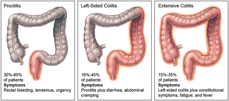 Figure 4-1:  UC Classification by Colonic Involvement (Montreal Classification). Source: Ungaro R, et al. Lancet. 2017;389(10080):1756-1770.