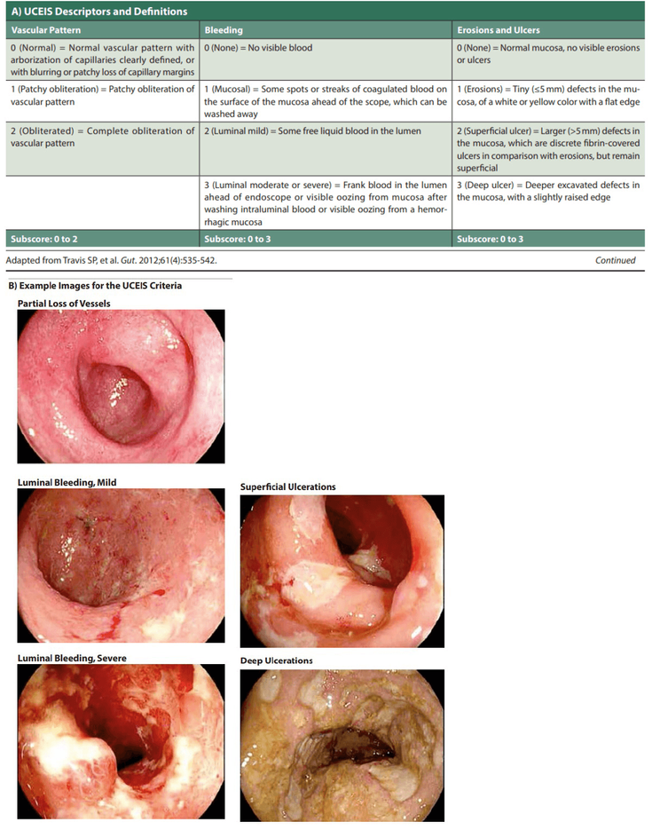 Figure 5-2: Ulcerative Colitis Endoscopic Index of Severity. Source: Adapted from Travis SP, et al. <em>Gut</em>. 2012;61(4):535-542. Images from Endoscopy Campus Magazine. https://www.endoscopy-campus.com/en/. Accessed November 2019.