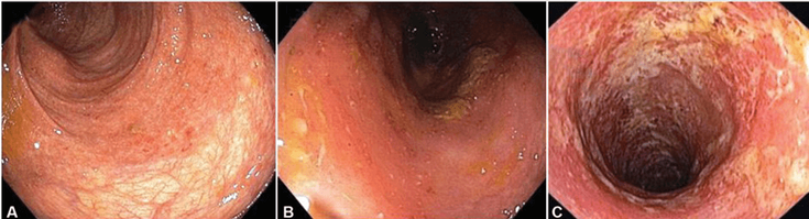 Figure 5-3: Endoscopy Images of Mild, Moderate, and Severe UC.  Key: Mild disease with erythema and decreased vascular pattern (A), moderate disease with loss of vascular pattern and erosions (B), and severe disease with diffuse ulcerations (C). Source: Modified from Ungaro R, et al. Lancet. 2017;389(10080):1756-1770.