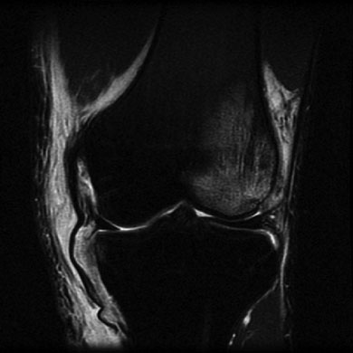 T2-weighted coronal MRI shows the distal avulsion of the MCL