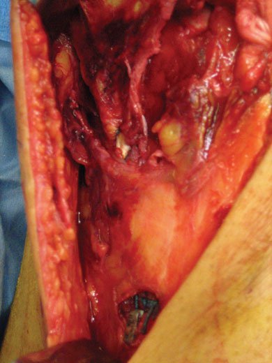 Intraoperative photograph showing the distal MCL avulsion repaired over a staple post