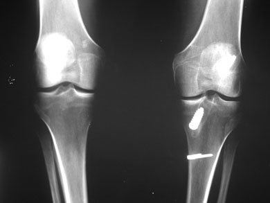 Postoperative anteroposterior (AP) x-ray after ACL reconstruction with bone-patellar tendon-bone (BTB) autograft and MCL repair over a staple