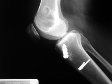 Postoperative lateral x-ray showing the fixation of both the ACL and MCL grafts