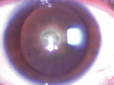 Classic appearance of central posterior polar cataract