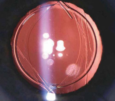 Optic capture. The IOL loops are situated anterior to the capsule bag while the optic has been deliberately displaced behind the anterior capsulorrhexis, creating stable fixation