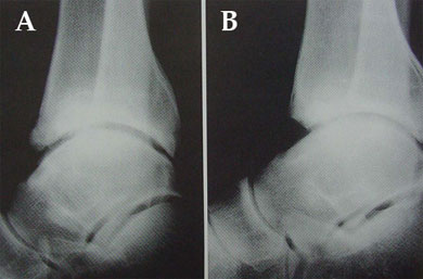 (A) Anterior osteophyte with tibiotalar angle more than 60 degrees. (B) Postresection