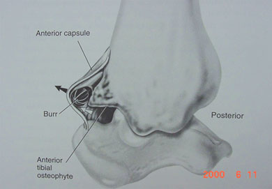 Anterior osteophyte right ankle with burr