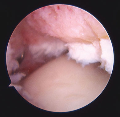 Anterior distal tibia after osteophyte removal