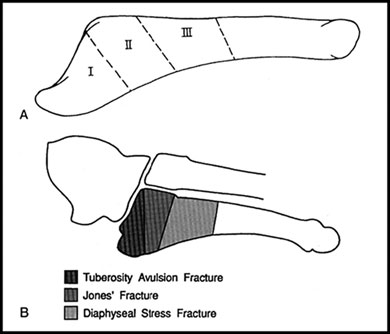 Zones and fracture patterns of the fifth metatarsal base