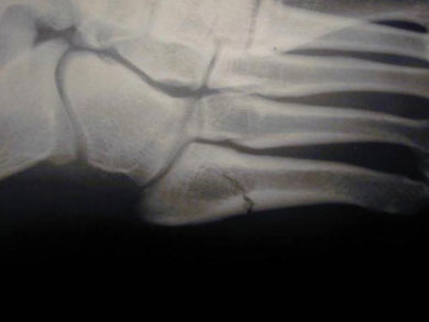 Acute Zone II Jones fracture