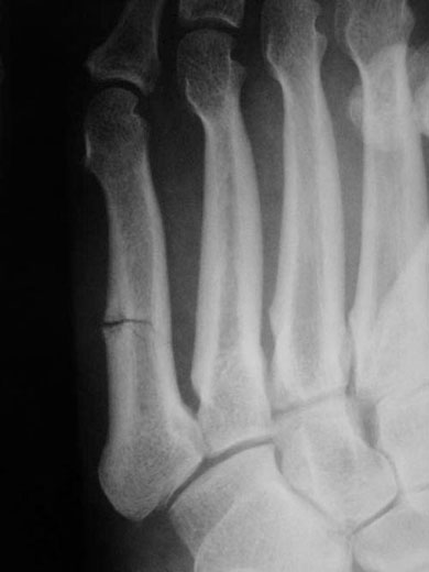 Zone III diaphyseal acute stress fracture