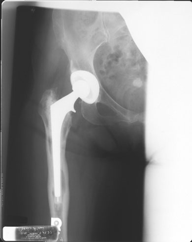 Preoperative roentgenogram of a symptomatic patient 3 years after total hip replacement. Note endosteal scalloping, generalized osteolysis, and cortical hypertrophy. Intraoperative cultures confirmed prosthetic joint infection