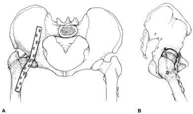 Preoperative roentgenogram of a symptomatic patient 15 years after total hip replacement and 3 years after revision of the acetabular component. Note circumferential radiolucencies, cortical discontinuity, and cement fracture. Gross loosening was confirmed intraoperatively