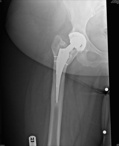 Preoperative roentgenogram 6 years after placement of a cementless proximally fixed tapered stem. Note subsidence, radiolucent lines, and formation of a pedestal. Gross loosening was confirmed intraoperatively